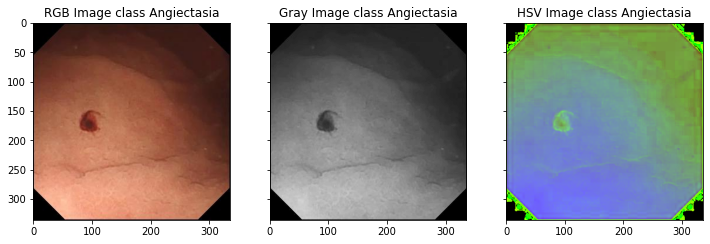 Angiectasia