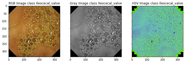 Ileocecal_valve