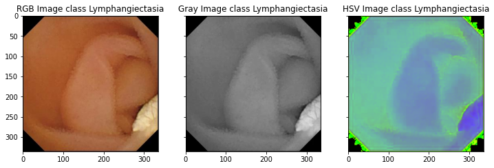 Lymphangiectasia